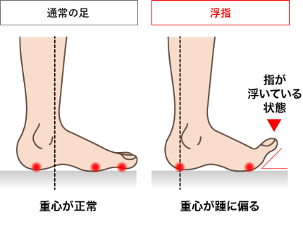通常の足と浮指の足