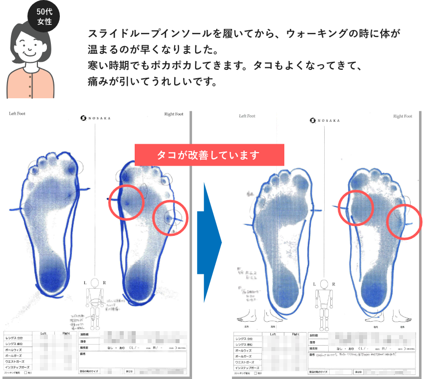 スライドループインソールを履いてから、ウォーキングの時に体が温まるのが早くなりました。 寒い時期でもポカポカしてきます。タコもよくなってきて、痛みが引いてうれしいです。