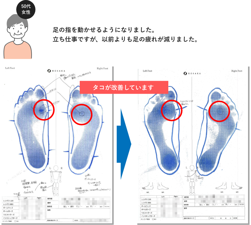 足の指を動かせるようになりました。 立ち仕事ですが、以前よりも足の疲れが減りました。